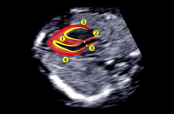 Fetal Congenital Anomalies – London School of Ultrasound