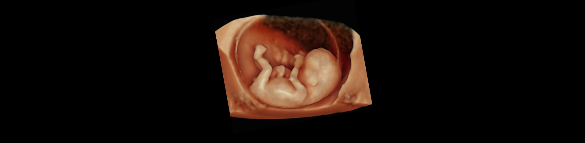 Early Fetal Scan Technique