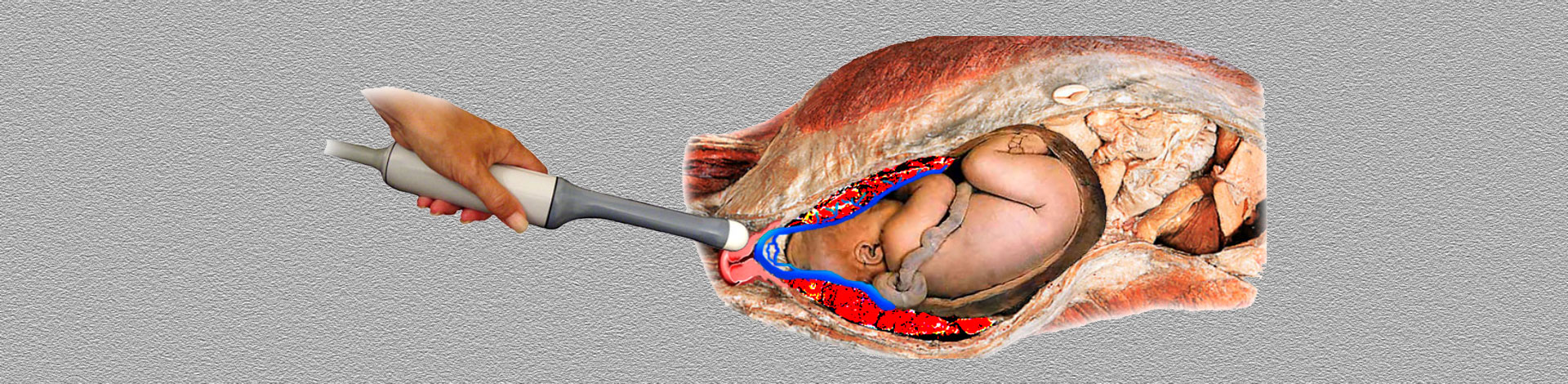 Transvaginal Scan (TVS) in  Fetal Medicine: Recording