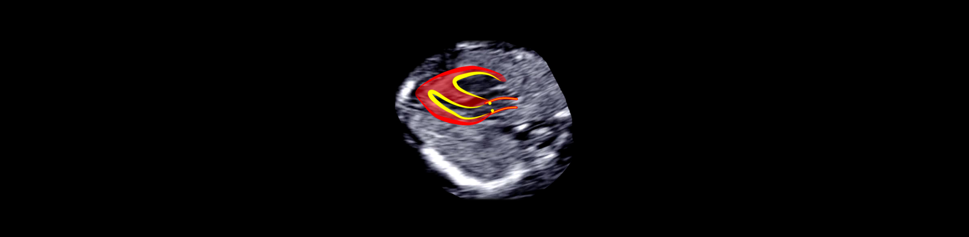 Fetal Heart: CHD-Advanced Diagnosis. Recording